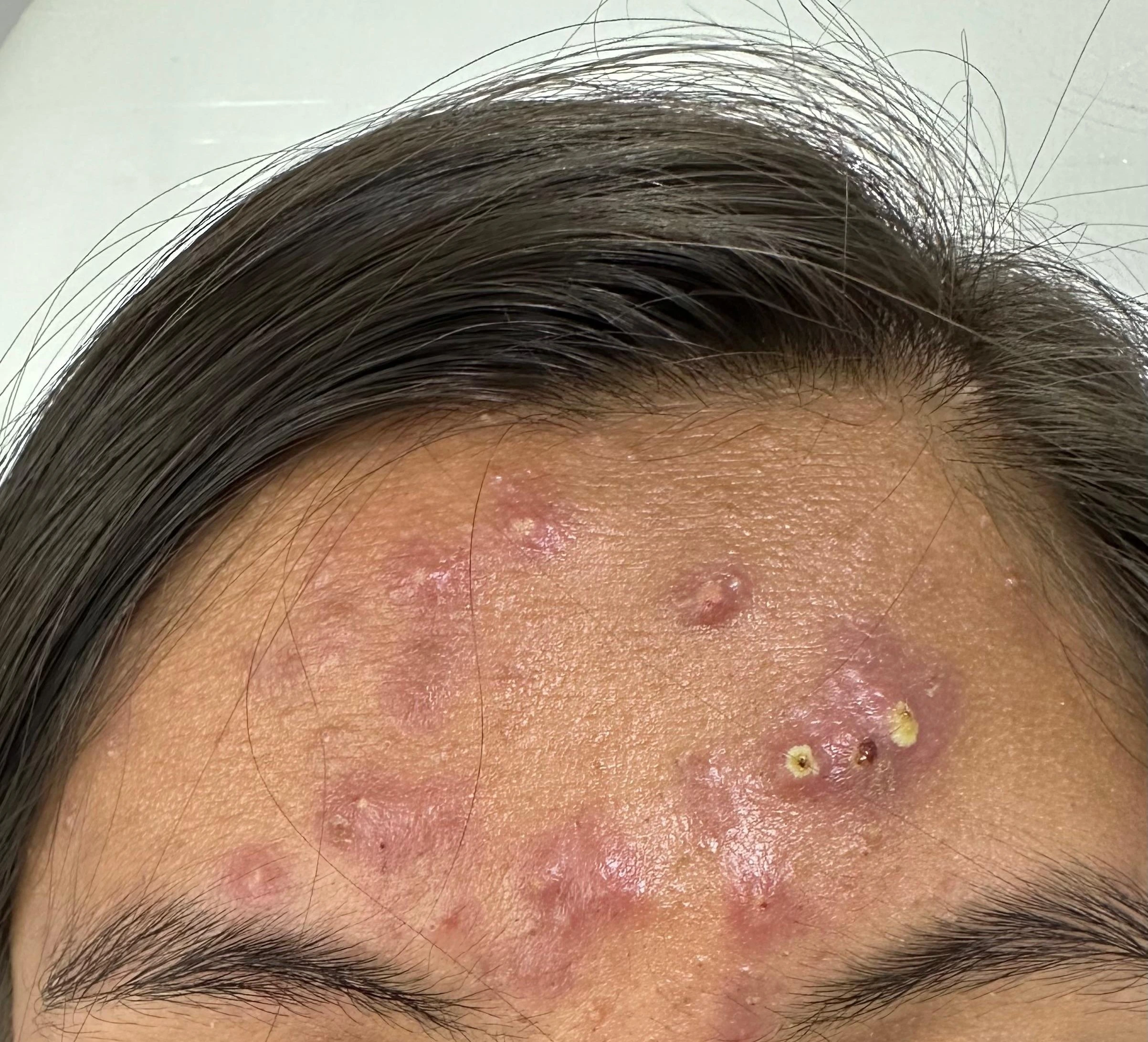 Tratamiento de Acné - Antes